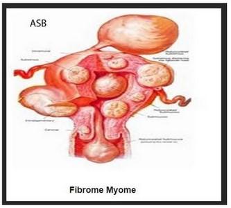 Fibrome uterin asb