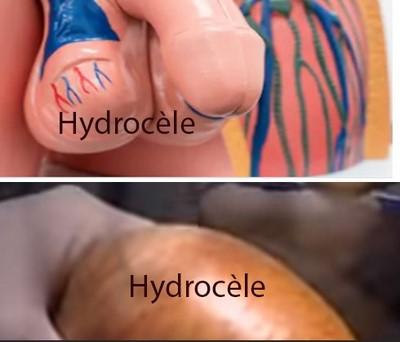 Hydrocèle vaginale, Hydrocèle testiculaire, Hydrocèle