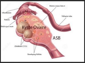 Kyste de l ovaire,Remèdes naturels Tumeurs Internes Kyste ovarien