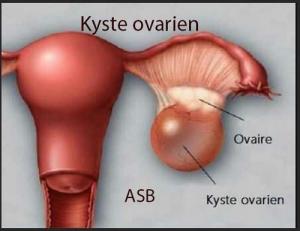 Kyste ovarien,  kyste de l'ovaire Remède Naturel