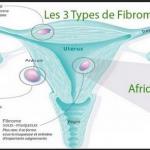 les 3 types de fibromes et Enlever Fibrome Naturellement