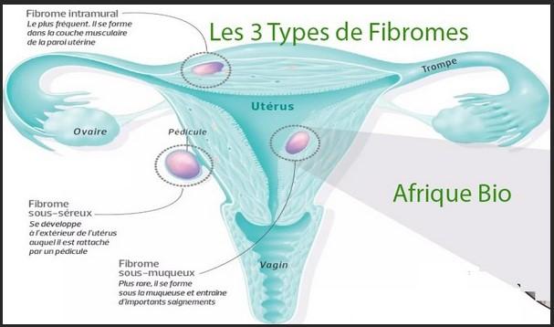 les 3 types de fibromes, Remède Naturel Enlever Myome