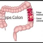 Polype colon ? remède naturel Polype Colon