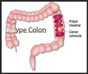 Polype colon asb