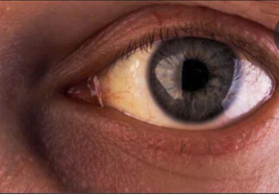 Syndrome de gilbert yeux