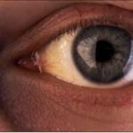 Syndrome de gilbert yeux