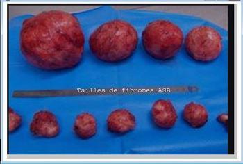 Tailles fibromes traitement