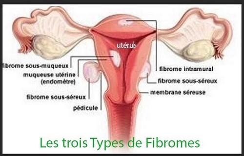 Three types fibroides asb