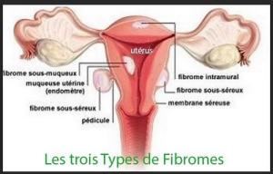 Trois types fibromes asb 1