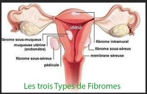 Trois types fibromes , Remèdes Naturels Tumeurs internes Fibrome