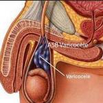 Varicose Testicles , Best Natural Remedy Varicocele