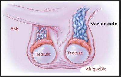 Varicocele ou varice de veine testicule
