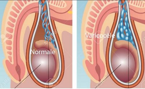 Varicocele varicose vein of the testicles